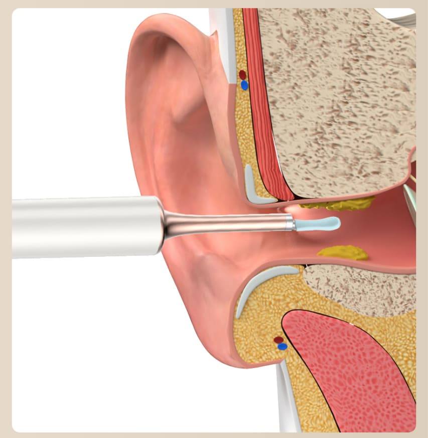 Eliminator de cerumă pentru curățarea urechii